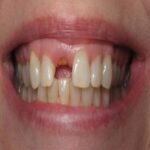 Sonhar com Dente Quenbrado da Frente Bicho