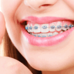 Sonhar com Aparelho de Dente Bicho