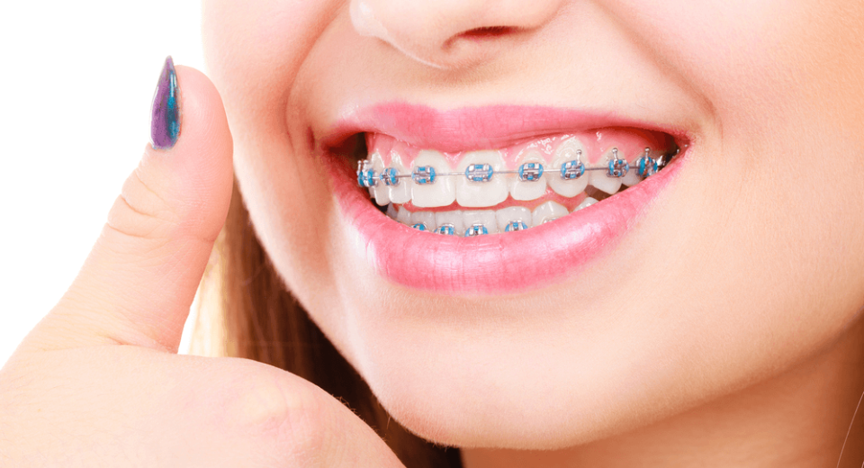 Sonhar com Aparelho de Dente Bicho