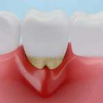 Sonhar com Dente Inflamado Loteria