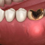 Sonhar com Dente Inflamado Bicho