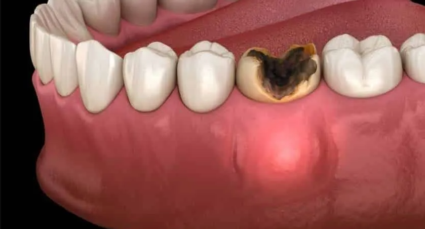 Sonhar com Dente Inflamado Bicho