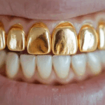 Sonhar com Dentes de Ouro Loteria