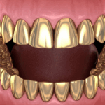 Sonhar com Dentes de Ouro Bicho