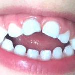Sonhar com Dente de Criança Loteria