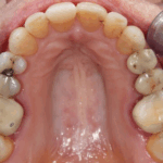 Sonhar com Dentes de Trás Caindo Loteria