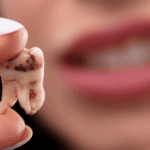 Sonhar com Dentes de Trás Caindo Bicho