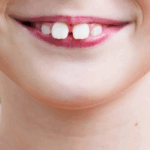 Sonhar com Dente Grande Loteria