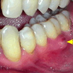 Sonhar com Dente Inchado Loteria