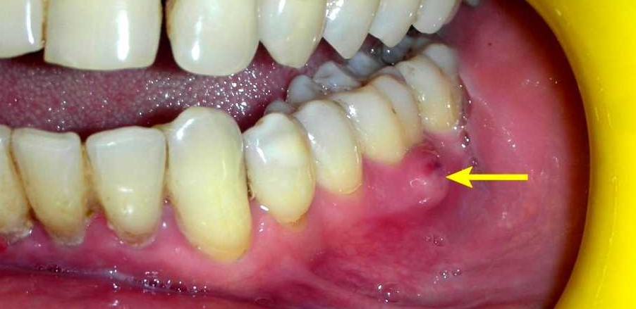 Sonhar com Dente Inchado Loteria