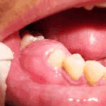 Sonhar com Dente Inchado Bicho