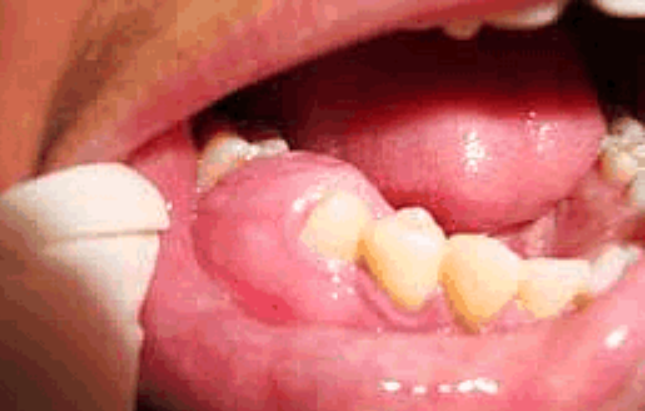 Sonhar com Dente Inchado Bicho