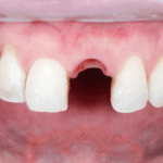 Sonhar com Dente Solto na Boca Loteria