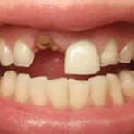 Sonhar com Dente Solto na Boca Bicho