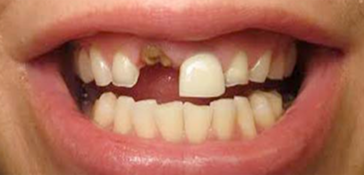 Sonhar com Dente Solto na Boca Bicho