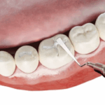 Sonhar com Obturador de Dente Bicho