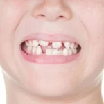 Sonhar com 2 Dentes Caindo Bicho