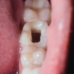 Sonhar com Buraco no Dente Loteria