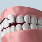 Sonhar com Cuspindo Dente Bicho