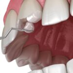 Sonhar com Cuspindo Dente Loteria