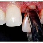 Sonhar com Dente Arrancado Bicho