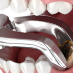 Sonhar com Dente Arrancado Loteria