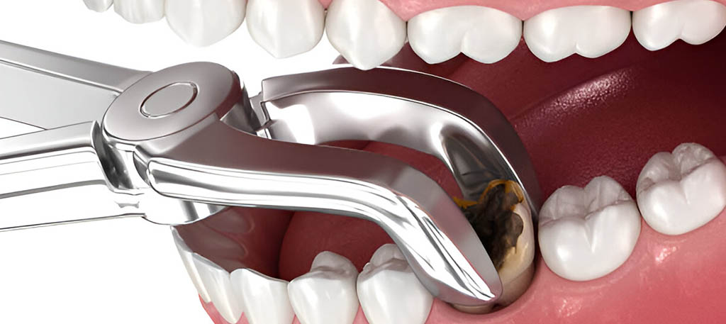 Sonhar com Dente Arrancado Loteria