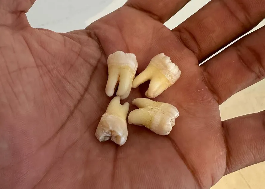 Sonhar com Dente Caindo na Mão Bicho