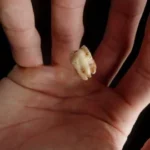 Sonhar com Dente Caindo na Mão Loteria