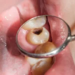 Sonhar com Dente Cariado Bicho