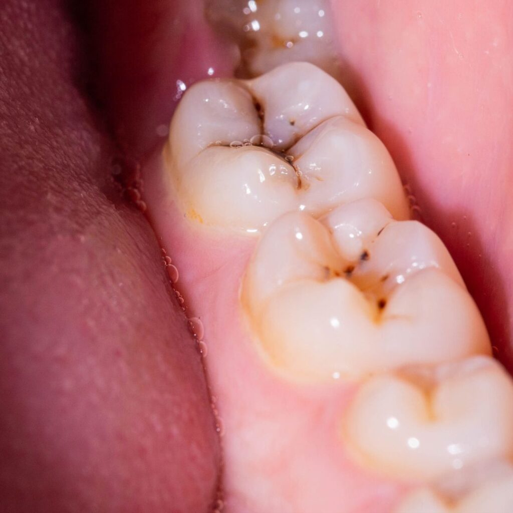 Sonhar com Dente Cariado Loteria