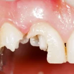 Sonhar com Dente Esfarelando Bicho