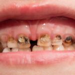 Sonhar com Dente Estragado Bicho