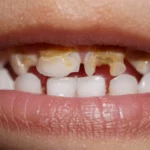 Sonhar com Dente Estragado Loteria