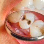 Sonhar com Dente Preto Bicho