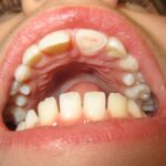 Sonhar com Dente Quenbrado da Frente Loteria