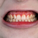 Sonhar com Dente Sangrando Bicho