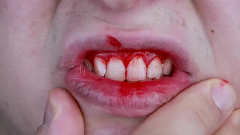 Sonhar com Dente Sangrando Loteria