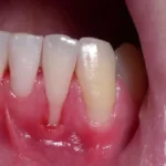 Sonhar com Dente Soltando da Gengiva Bicho