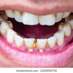 Sonhar com Dente Sujo Bicho