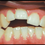 Sonhar com Dente Torto Bicho