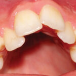 Sonhar com Dente Torto Loteria