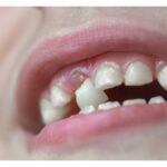 Sonhar com Dente de Leite Loteria