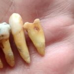 Sonhar com Dente de Outra Pessoa Bicho