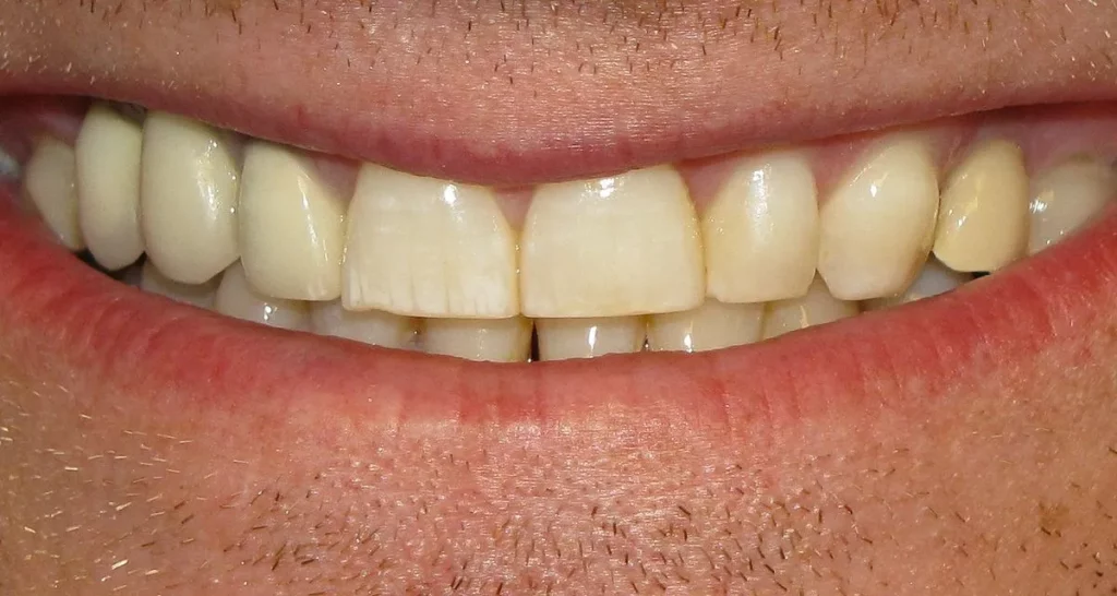 Sonhar com Dentes Amarelos Loteria
