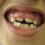 Sonhar com Engolindo Dente Bicho