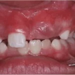Sonhar com Engolindo Dente Loteria