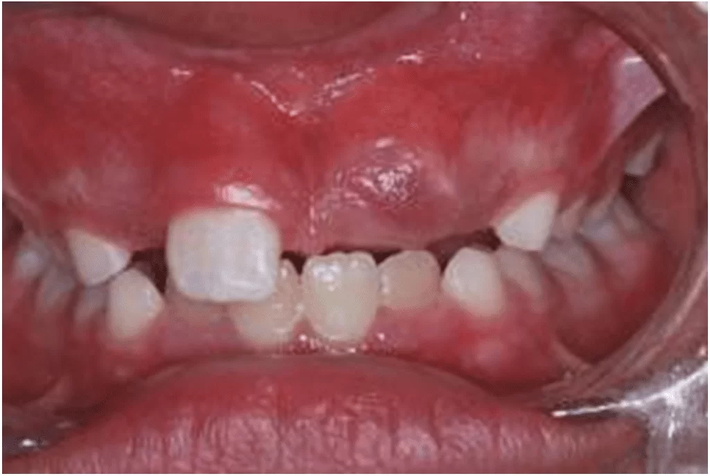 Sonhar com Engolindo Dente Loteria