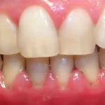 Sonhar com Gengiva de Dente Bicho