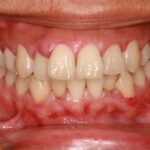 Sonhar com Gengiva de Dente Loteria